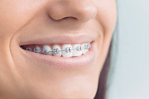 Best Wisdom Tooth Removal  in Perry Park, CO